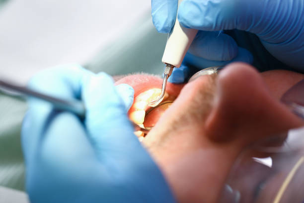 Best Knocked-Out Tooth (Avulsed Tooth) Treatment in Homeland, CA